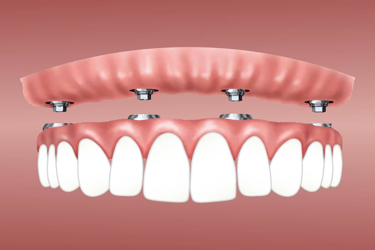 אילו טיפולי שיניים הם טיפולים משמרים ואילו משקמים?