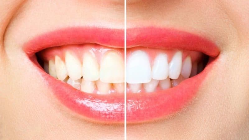 כמה עולה הלבנת שיניים