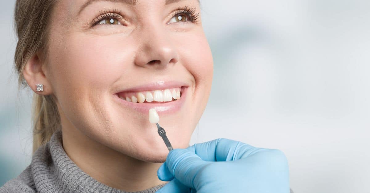ציפוי חרסינה לשיניים - המדריך המקוצר